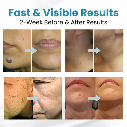Non-Invasive Mole and Wart Removal Laser Pen