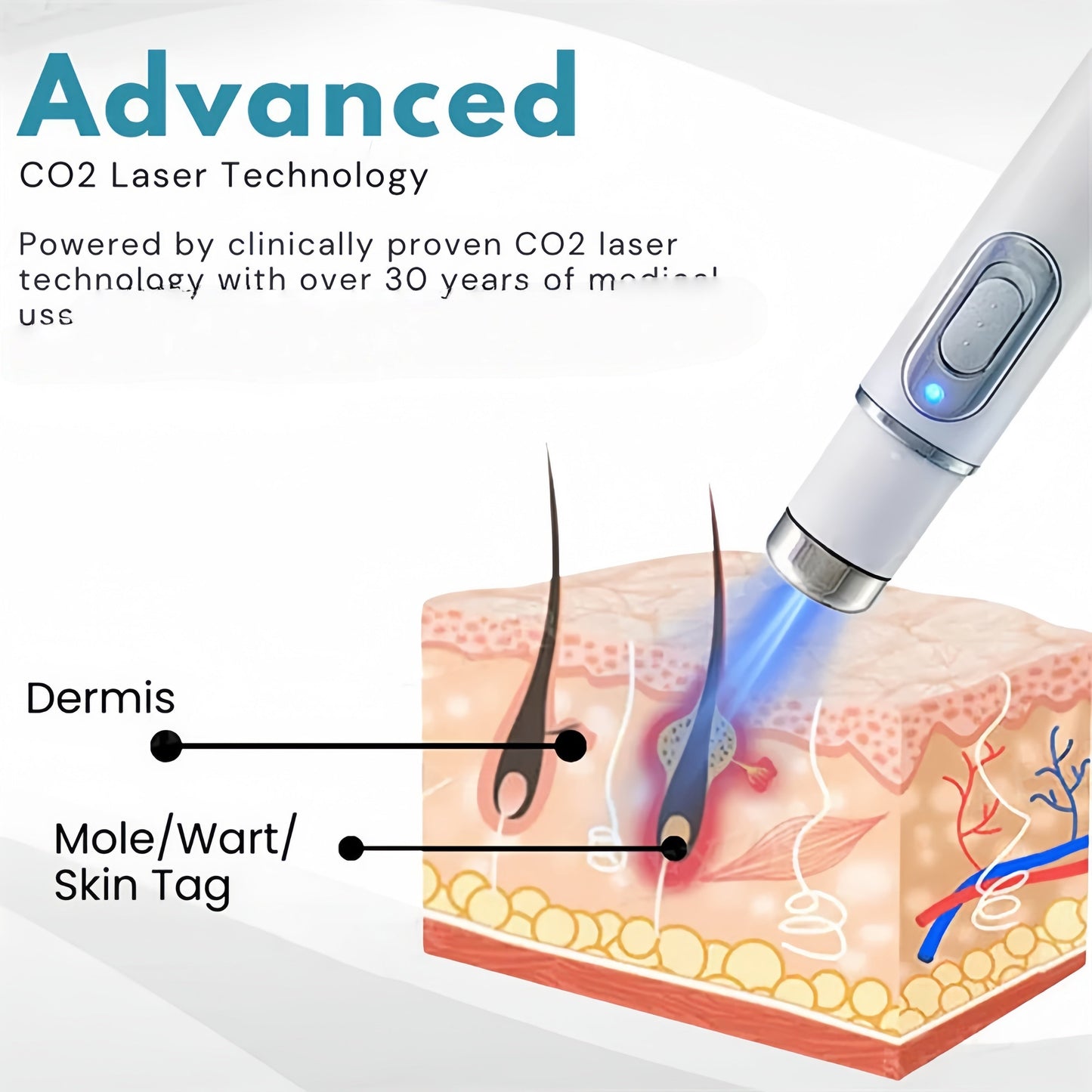 Non-Invasive Mole and Wart Removal Laser Pen